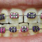Bye-Bye Braces