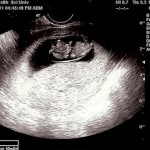 Ever had a Miscarriage? READ THIS!